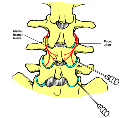 Facet Joint Injections and Medial Branch Blocks